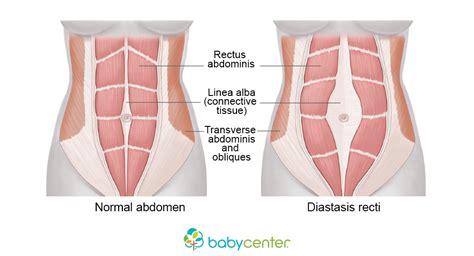 DRAM | Diastasis Recti and Exercise