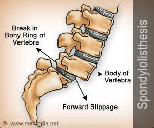 Spondylolisthesis - Causes Symptoms Diagnosis Treatment Prevention