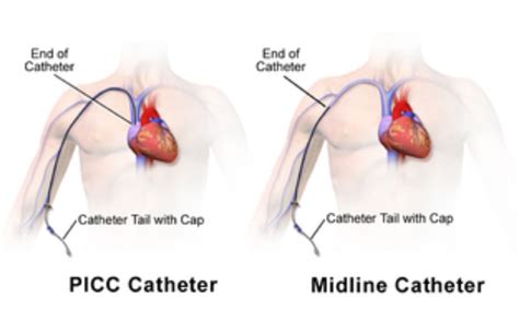 35+ Picc Line Diagram - VickieNevaeh