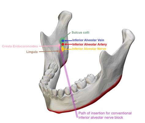 [Figure, Conventional inferior alveolar nerve block...] - StatPearls ...