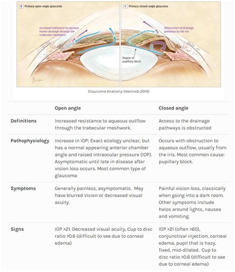 Acute Angle Glaucoma Symptoms