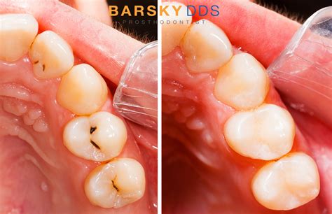 Dental Fillings in Miami with Dr. Barsky | Barsky DDS