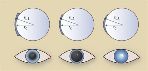 FITTING PROCEDURE FOR RIGID CONTACT LENS - Optography