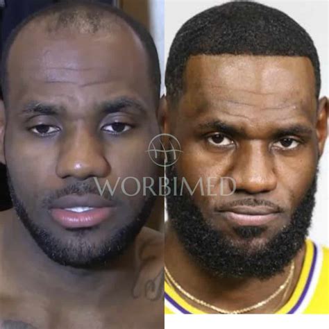 LeBron James Hair Transplant l Before and After