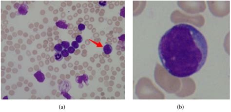 Acute Lymphoblastic Leukemia | Concise Medical Knowledge