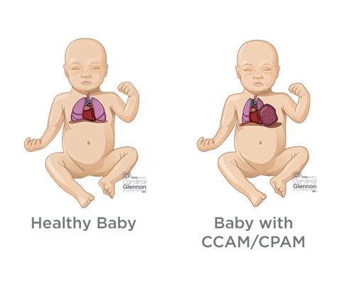 Fetal Lung Masses: Diagnosis, Treatments & Expectancy | SSM Health