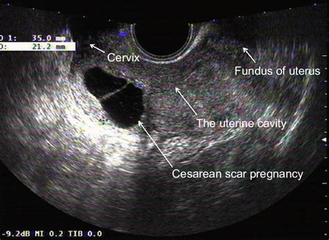 Uterine Cavity Ultrasound