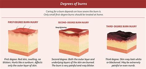 Burn Degrees Chart