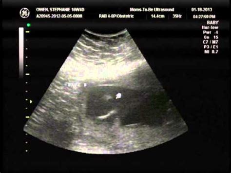 3D/4D Ultrasound 1/18/13 - Twin Gender Reveal - YouTube