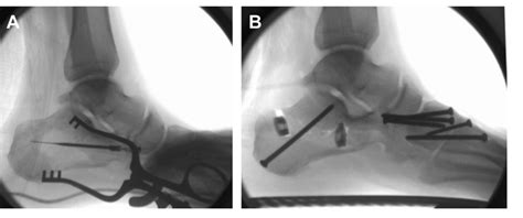 Calcaneal Osteotomies Tips and Tricks — Doctor Andrés León - Consulta ...