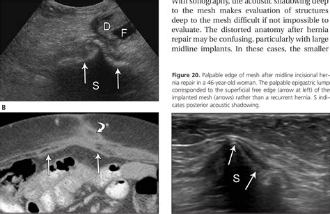 Inguinal Hernia Mesh Ultrasound