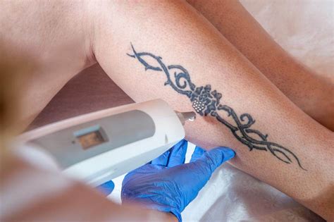 Miami Center for Cosmetic Dermatology – Dr. Deborah LongwillTattoo Removal Options | Miami ...