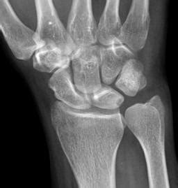 Distal Radial Ulnar Joint (DRUJ) Injuries - Trauma - Orthobullets