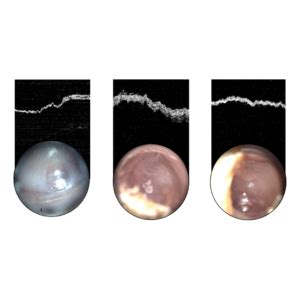 What a Middle Ear Infection Looks Like Using the OtoSight Middle Ear Scope - PhotoniCare