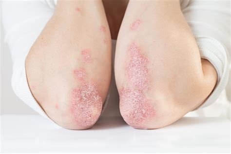 Everything you need to know about psoriasis | Curology