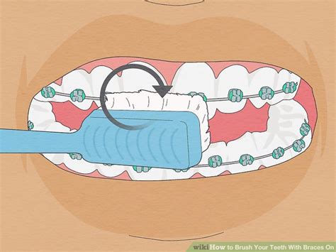 How to Brush Your Teeth With Braces On (with Pictures) - wikiHow