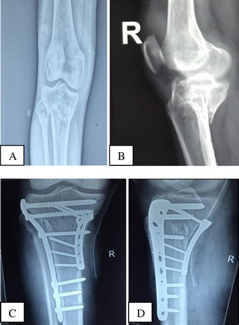 Posteromedial fragment fixation through Lobenhoffer approach in tibial plateau fractures ...