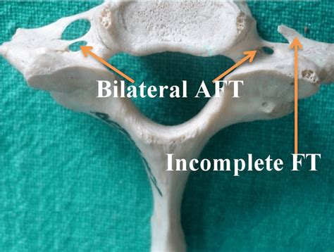 Showing bilateral Accessory Foramen Transversarium (AFT) & incomplete ...