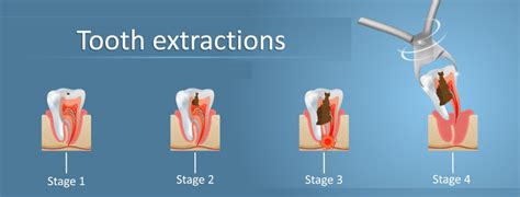 Tooth Extraction | Huntington Beach, CA | Pain relief with Oral surgery | Orange County ...