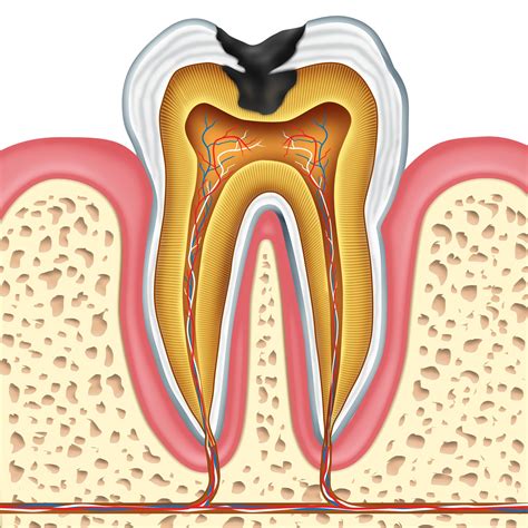 Memphis, TN Cavities and Missing Teeth - Tooth Decay Consequences