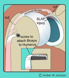 Why do I need a biceps tenodesis for a labrum tear? | North Jersey Orthopaedic Clinic Blog ...