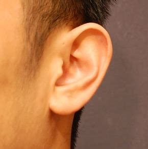 San Jose Ear Surgery Before and After Photos - San Francisco Plastic ...