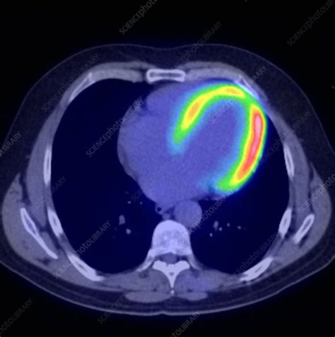 Cardiac insufficiency, PET scan - Stock Image - C001/7589 - Science Photo Library