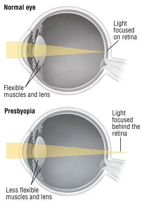Presbyopia Guide: Causes, Symptoms and Treatment Options