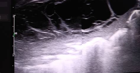 SONO DIGEST: ULTRASOUND CHEST- Empyema thoracis & Enlarged Thymus