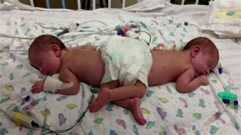 conjoined twins | 6abc.com