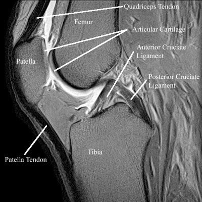 Radiology Anatomy Images : Patellar articular cartillage in MRI Knee ...