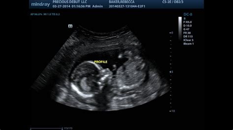 17 Week Ultrasound - YouTube