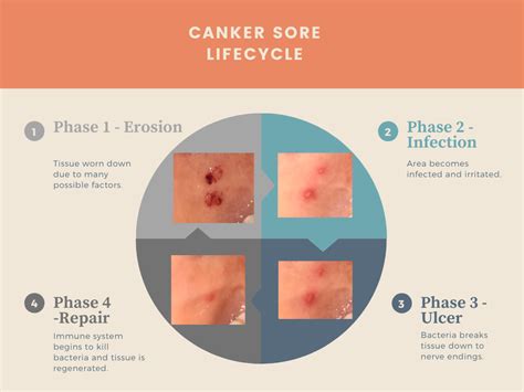 Mouth Ulcer / Canker Sore Diagram — Canker Shield