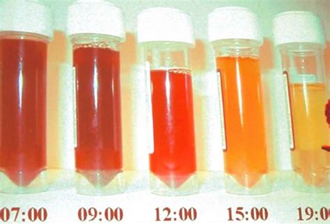 Hemoglobinuria, paroxysmal nocturnal hemoglobinuria & paroxysmal cold ...