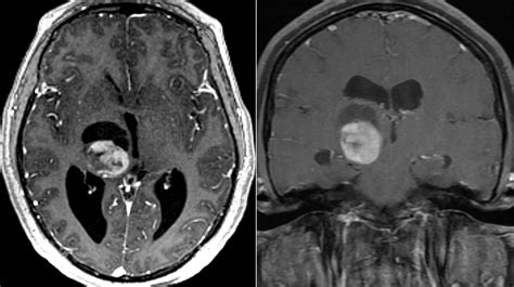 Thalamus Anatomy Mri