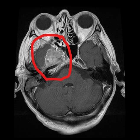 Nasopharyngeal carcinoma MRI - wikidoc