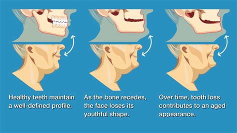 Wisdom Teeth Nerve Damage – Boston Dentist – Congress Dental Group 160 ...