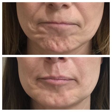 Botox Injections in the Chin? - clinetix : clinetix