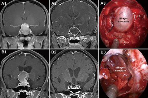 Frontiers | Identification of the Extradural and Intradural Extension of Pituitary Adenomas to ...