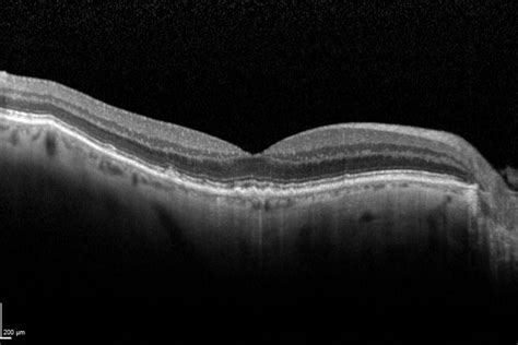 Geographic Atrophy Segmentation Using SD-OCT Images