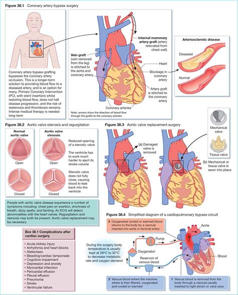 Principles of cardiac surgery | Nurse Key