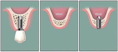 Sinus lift procedure | Fiveways Dental