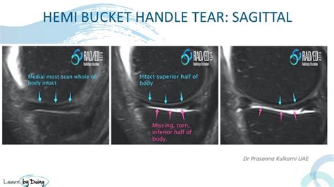 Hemi Bucket Handle Tear Knee MRI - Radiology Education Asia