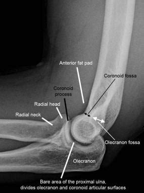 Imaging of Elbow Fractures and Dislocations in Adults: Practice Essentials, Radiography ...