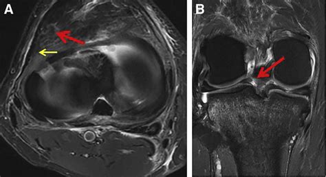 (A) Axial MRI image of a right knee demonstrating a radial tear of the... | Download Scientific ...