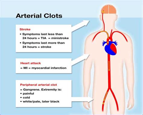 What is a blood clot? | UNC Hemophilia and Thrombosis Center