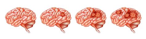 Different stages of cancer in brain 299244 Vector Art at Vecteezy