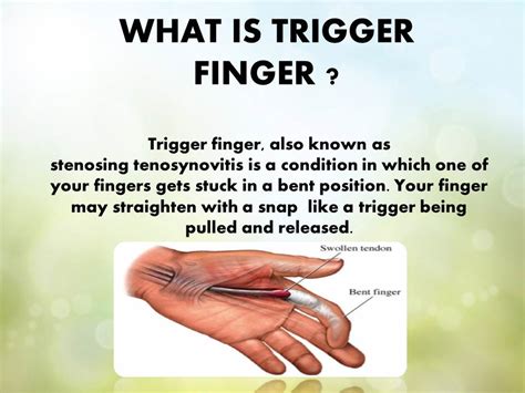 Trigger Finger Definition Etiology Symptoms Diagnosis