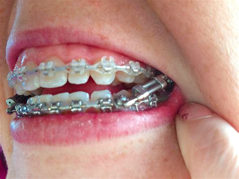 Orthodontic Appliances and Spacers | Marc Allen Orthodontics