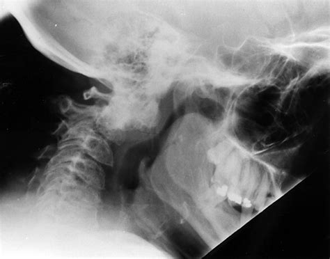 An unusual cause of atlanto-axial subluxation | Annals of the Rheumatic Diseases